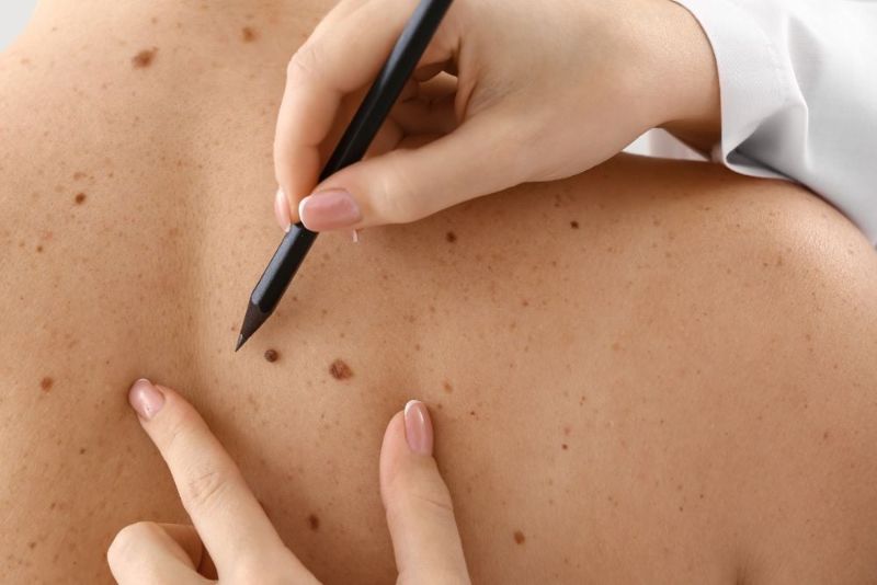 Warts removal at Scapio Family Beauty Salon in Near Traffic Police station P.M.Palem